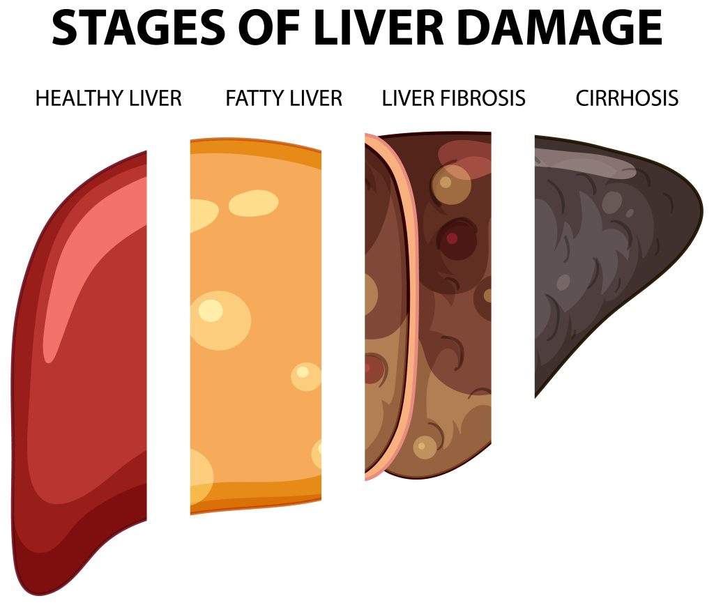 Stages of liver damage